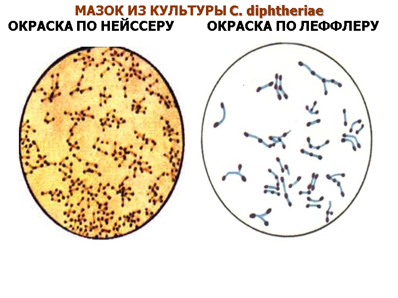МАЗОК ИЗ КУЛЬТУРЫ C. diphtheriae   ОКРАСКА ПО НЕЙССЕРУ    